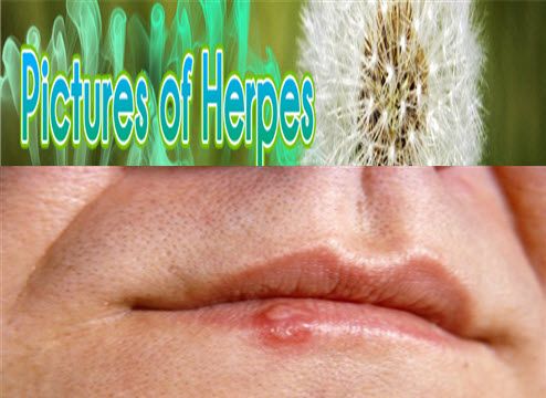 oral herpes pictures on lips