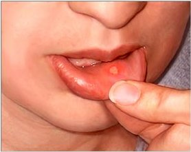 is oral herpes curable